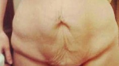 Muž zaplatil manželke odstránenie ovisnutej kože. Výsledok je dokonalý