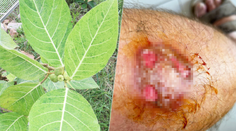 Vážne popáleniny mu spôsobila miazga zo známeho kríka. Pán Martin varuje aj ostatných záhradkárov