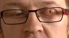 Unikátna operácia! Zrak mu vrátili pomocou zubu