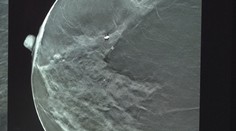 Inovácia, ktorá mení životy. Slovensko má novú metódu v boji s rakovinou