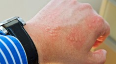 Žihľavka nie je len kožný problém. Naznačuje poruchu imunity