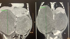 Extrémne náročné operácie sa podarili: Chlapcovi v Bratislave odstránili dva veľké obojstranné nádory na obličkách