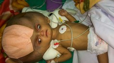 Chlapca, ktorý trpí vzácnou chorobou, operovali. Zmenšili mu hlavičku