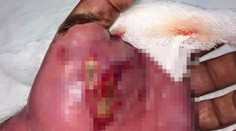 Len pre silné žalúdky: Takto vyzerá uhryznutie od štrkáča