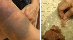 Dobitá, ešte aj prišla o zuby. Žena doplatila na stav nemocnice