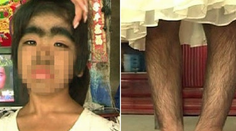 Ľudia sa jej boja. Dievčatko trápi vzácna choroba