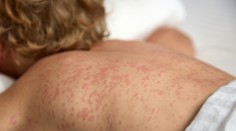 V Bratislave sa v krátkom čase nakazilo osýpkami už tretie dieťa. Hygienici sa obávajú vzniku malých ohnísk nákazy