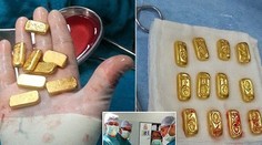 Šokovaní lekári vyoperovali pacientovi z brucha 12 zlatých tehličiek