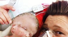 V Sydney sa narodili vzácne dvojčatá s jedným telom a dvoma tvárami