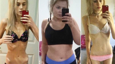 Šokujúce snímky. Pre posmešky schudla na kosť a kožu