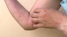 USA vyhlásili v súvislosti s opičími kiahňami stav zdravotnej núdze