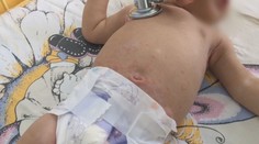 Zaočkovanosť proti osýpkam klesá. Pediatri pripúšťajú vznik epidémie