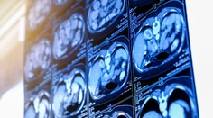 Nápoje sladené cukrom môžu ženám po menopauze zvýšiť riziko rakoviny pečene, zistila nová štúdia