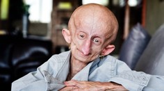 Stala sa hlasom ľudí so vzácnou genetickou poruchou. Hviezda TikToku zomrela vo veku 19 rokov