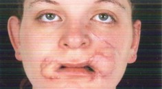 Na tehotnú Lauru (21) zaútočil pes. Z tváre jej vytrhal kusy mäsa