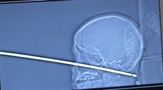 Tínedžer padol zo stromu na ražeň, zázrakom prežil