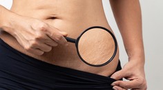 Trápia vás strie a vrásky? Teraz je správny čas na ich odstránenie