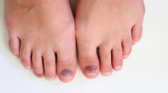 Myslela si, že ide iba o kozmetický problém. Z modriny pod nechtom sa vykľula zákerná choroba