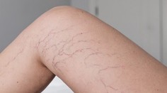 Myslíte si, že sú to len žilky? Metličky na nohách môžu byť varovným signálom