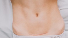 TOP 11 faktov, ktoré by ste mali vedieť o cisárskom reze