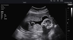 Žene počas unikátnej operácie vybrali z tela maternicu aj s dieťaťom. Môj syn sa narodil dvakrát, hovorí mamička