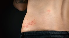 Nebezpečný pásový opar. Pre toto si naň dajte pozor a predchádzajte mu