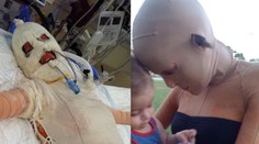 Žiarlivá žena ju podpálila. Dva a pol roka nosila masku, dnes vyzerá úžasne