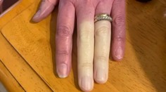 Žena trpí vzácnym ochorením. Keď je v chlade, jej prsty zblednú a prežíva veľké bolesti