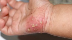 Svrab sa šíri rýchlo a nenápadne. Spoznajte príznaky, kým nie je neskoro