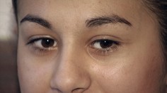 Odmietla bratranca a prišla o nohu. Smutný príbeh tínedžerky