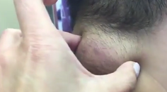 Na krku mal hrču veľkú ako golfová loptička. To, čo z nej vyliezlo, je len pre silné žalúdky