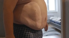 Obezita je choroba a treba ju liečiť, vravia lekári. Ministerstvo to vidí inak