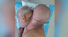 Lekári ostali v šoku: Muž žil 16 rokov s nádorom veľkým ako hlava