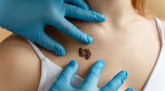 Kontrolujete si znamienka? Tieto varovné príznaky by ste nemali ignorovať