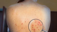 Ďalší štát mimo Afriky ohlásil prvé úmrtie spojené s opičími kiahňami