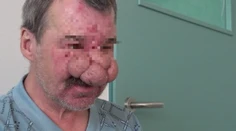 Kvôli nosu si zažil peklo. Teraz urobil radikálne rozhodnutie a my sme boli pri tom