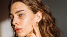 Šíri sa návod, ako sa zázračne zbavíte akné. Dermatologička vysvetľuje, prečo je to hrozný nápad