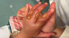 Dievča sa popŕhlilo o jedovatú rastlinu, skončilo s pľuzgiermi. Invázny druh rastie aj u nás