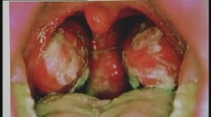 Choroba, ktorú odhalíte až po mesiacoch. Občas vyvolá rakovinu