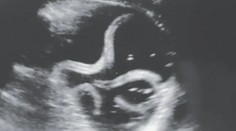 Nepríjemný nález ultrazvukom: Mužovi žili v žalúdku červy