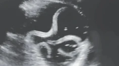 Nepríjemný nález ultrazvukom: Mužovi žili v žalúdku červy