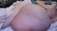 Češka zaujala svetové médiá: Vyoperovali jej 36-kilový tumor