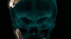 Objavili doteraz neznámy druh predka človeka. Bol podobný neandertálcom