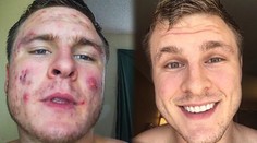 Kulturista, ktorý zdolal hrozné akné v novom videu odhalil ďalšie rady