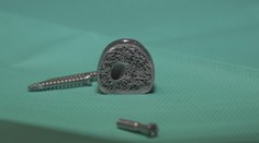 Unikátna operácia: Roman (50) dostal medzistavcovú platničku z 3D tlačiarne