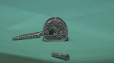 Unikátna operácia: Roman (50) dostal medzistavcovú platničku z 3D tlačiarne