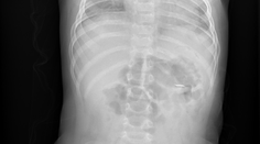 Nemocnica varuje rodičov. Viacero batoliat prehltlo ostrý pliešok z e-cigariet, môže ich vážne zraniť