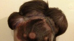 Unikátna operácia: Dievča si poriadne vytrpelo, teraz je krásna