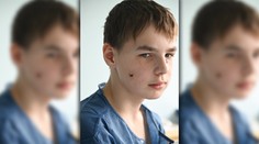 Je dieťa a už vie, čo je to vojnové zranenie. Slovenskí lekári zachránili tvár chlapcovi, ktorý prežil bombardovanie Charkova