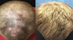 Dobrá správa! Lekári našli liek na vypadávanie vlasov